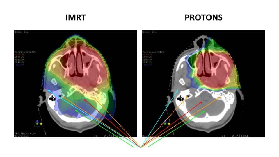 X-ray of radiation of IMRT and Protons